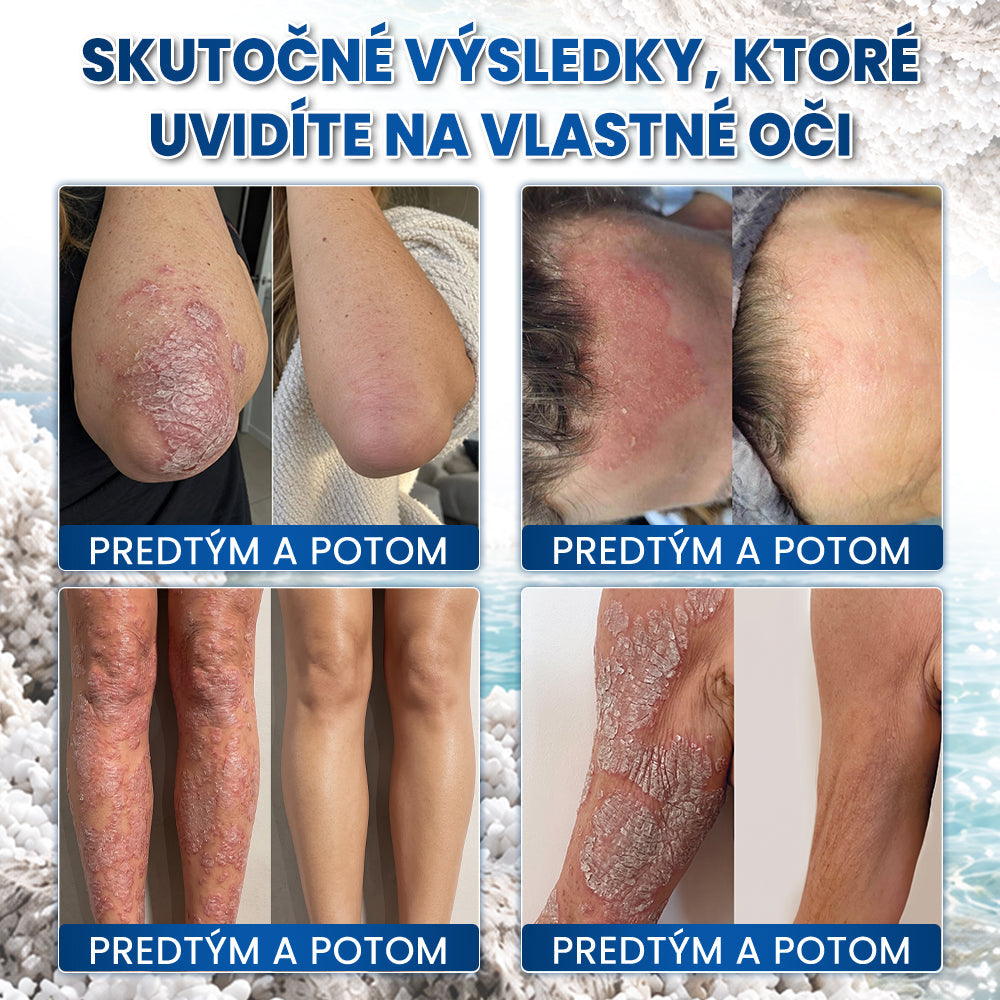 ✨✨✨Medistart® ŠPECIÁLNA STAROSTLIVOSŤ O POKOŽKU PRI PSORIÁZE