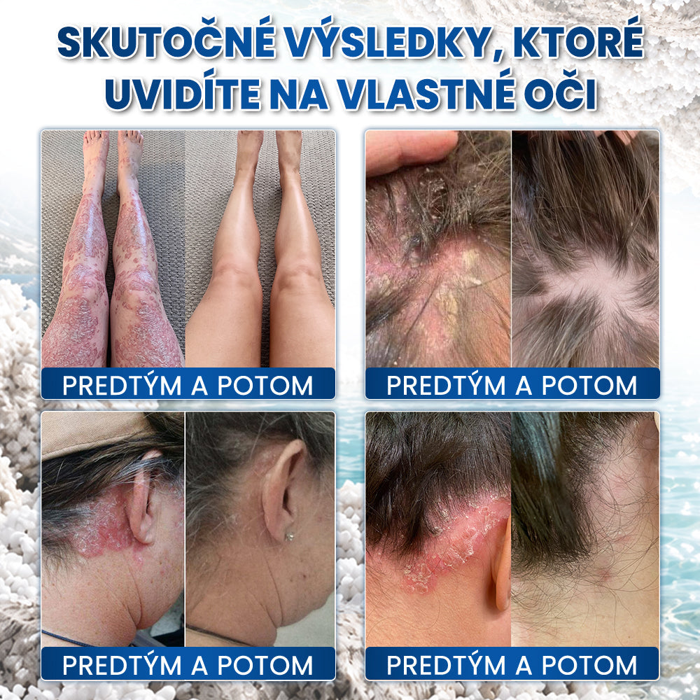 ✨✨✨Medistart® ŠPECIÁLNA STAROSTLIVOSŤ O POKOŽKU PRI PSORIÁZE