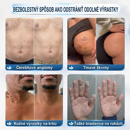 PuraCure® 👩‍⚕️ 7-dňové pero na odstraňovanie kožných výrastkov a znamienok – bezbolestný a bez jaziev, profesionálny valčekový aplikátor