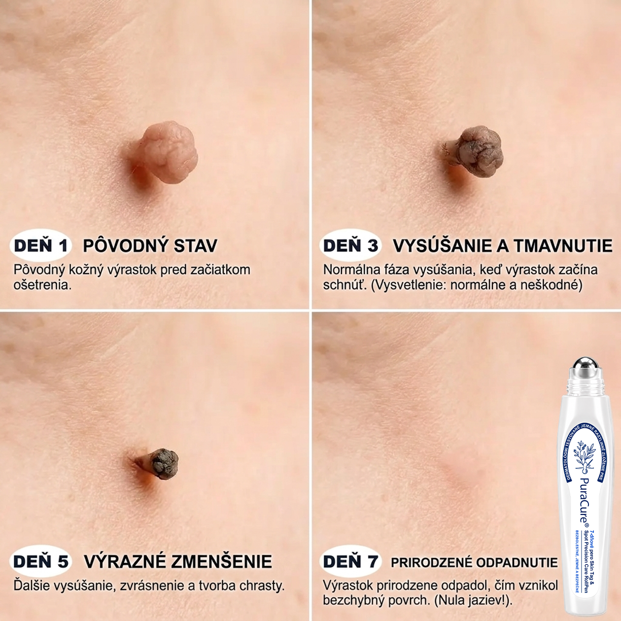 PuraCure® 👩‍⚕️ 7-dňové pero na odstraňovanie kožných výrastkov a znamienok – bezbolestný a bez jaziev, profesionálny valčekový aplikátor